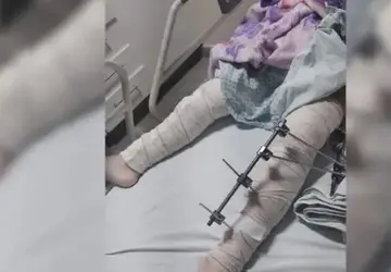 Médicos fazem cirurgia em perna errada de criança na PB; equipe é afastada