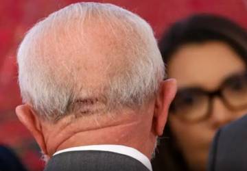 Entenda o que é trepanação, cirurgia no crânio pela qual Lula passou