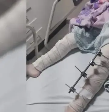 Médicos fazem cirurgia em perna errada de criança na PB; equipe é afastada